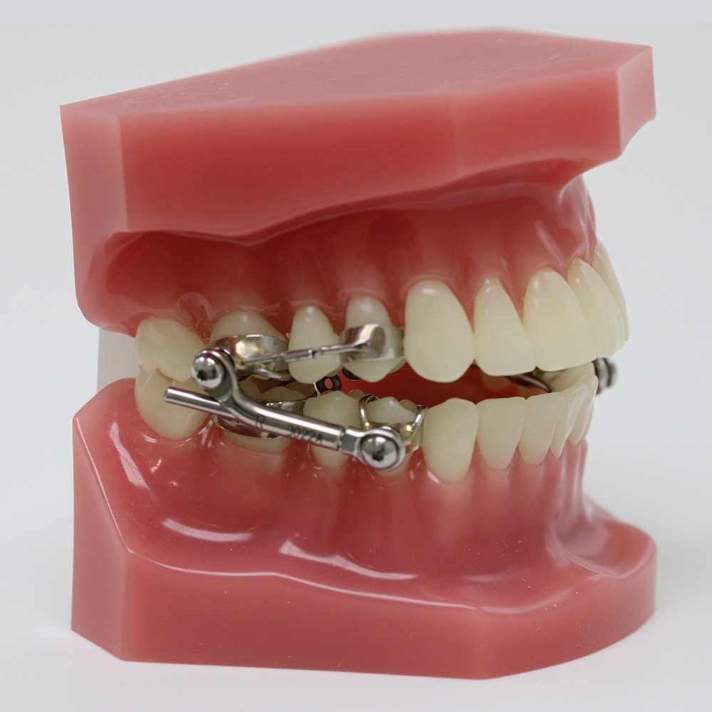 Herbst Beugel Om Overbeet Herstellen Orthodontie Eemland